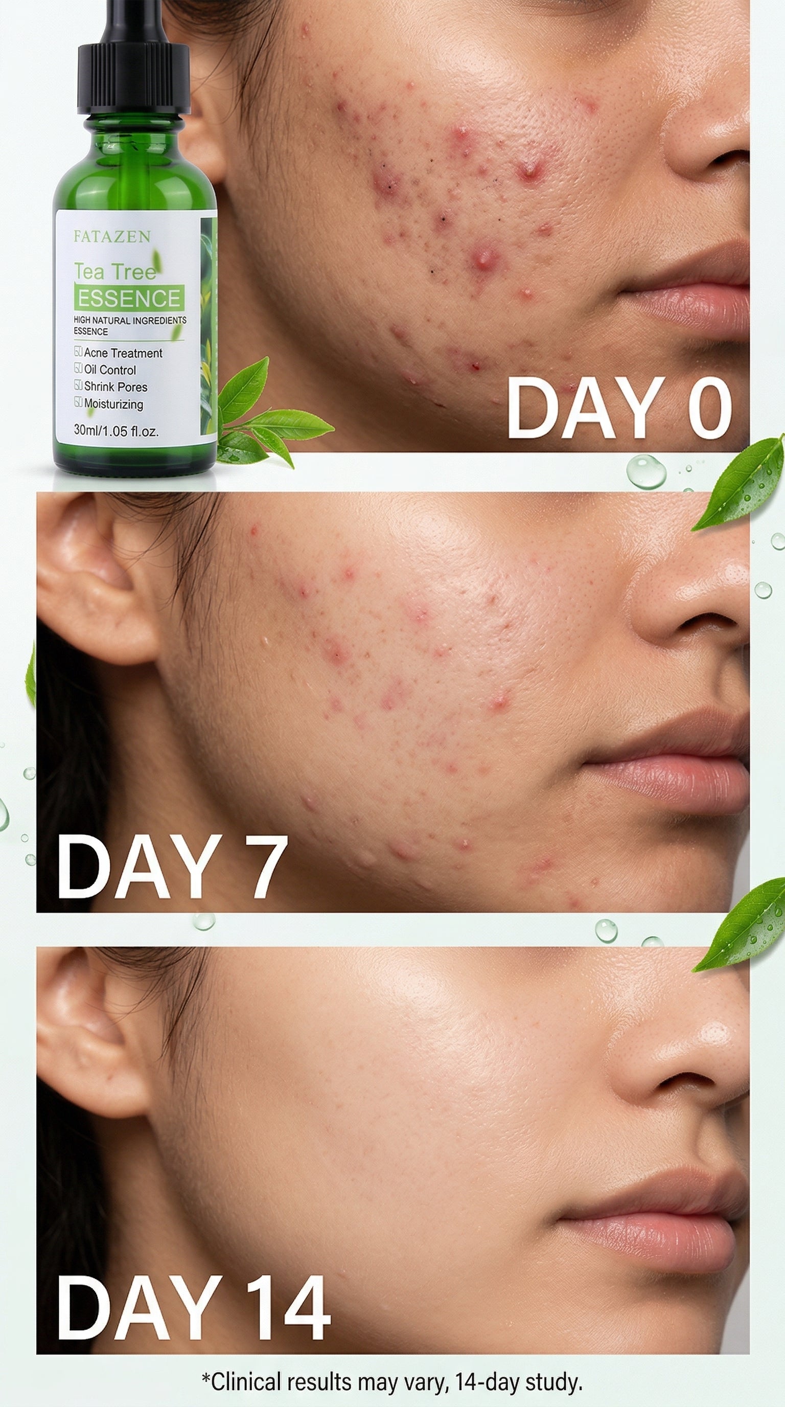 Before and after comparison of acne treatment with a bottle labeled 'Day 0', 'Day 7', and 'Day 14'.