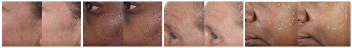 Dark spots and uneven skin tone on sensitive skin