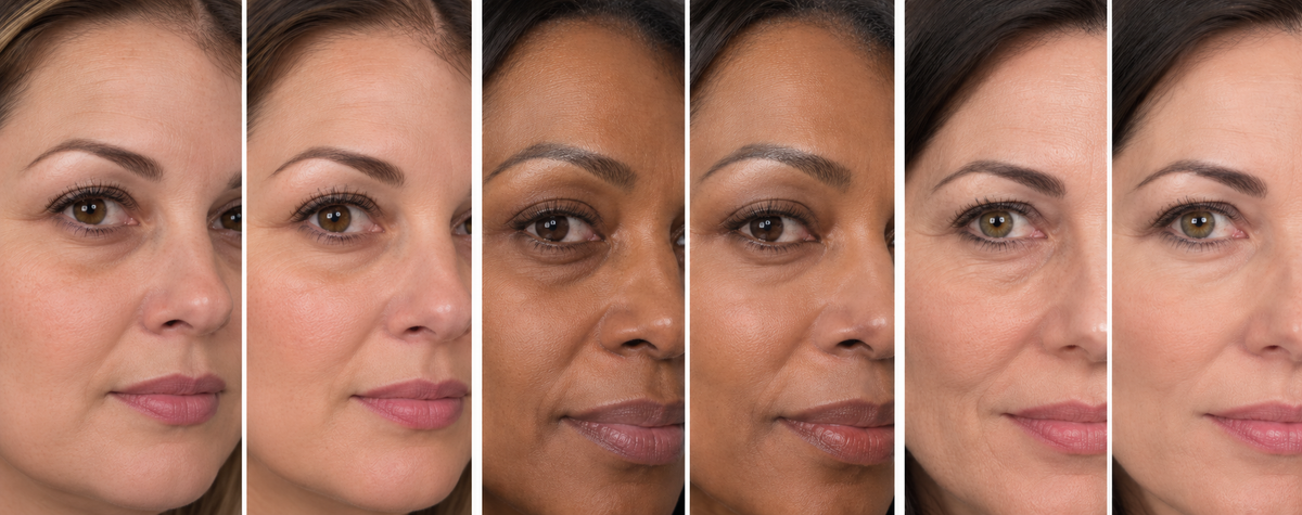 Close-up of the under-eye area showing puffiness and fine lines
