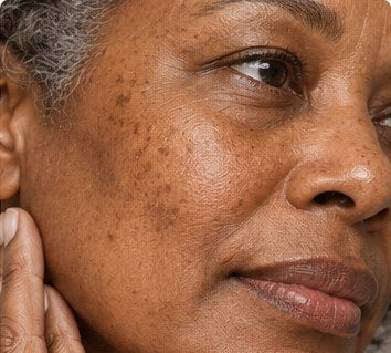 Uneven tone + sensitive skin